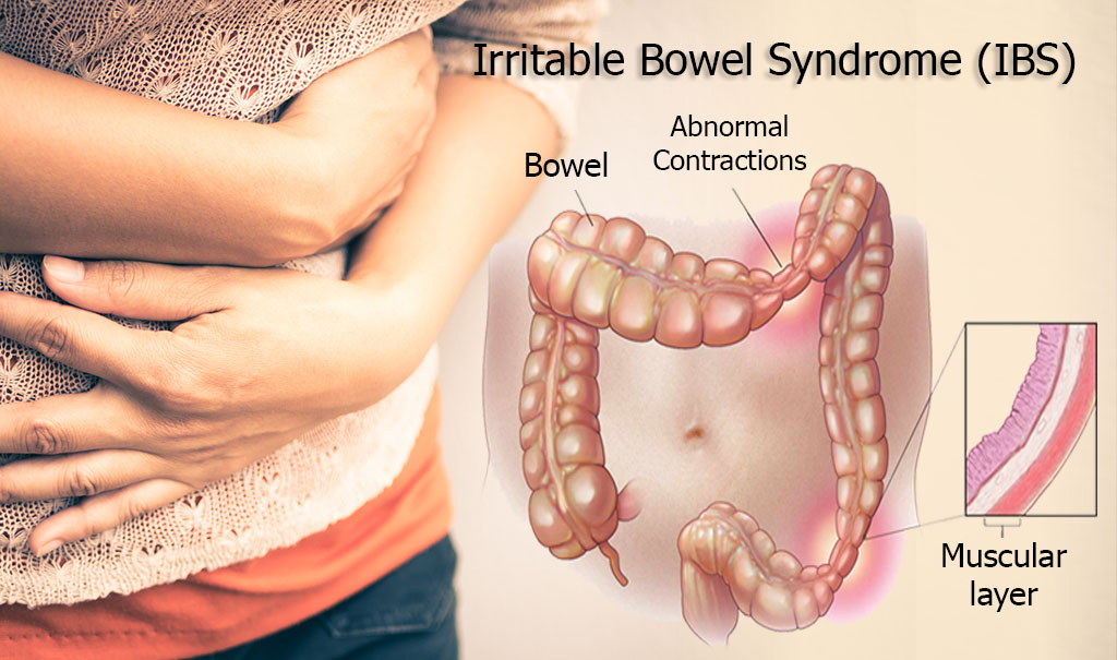 Alimentos prohibidos sindrome intestino irritable